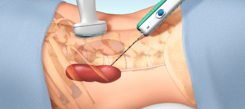 Liver Biopsy