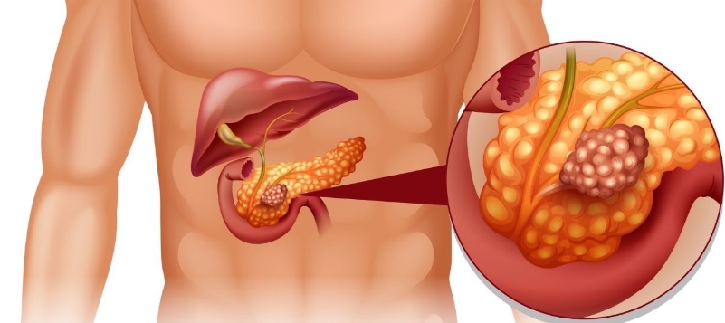 Pancreas Biopsy